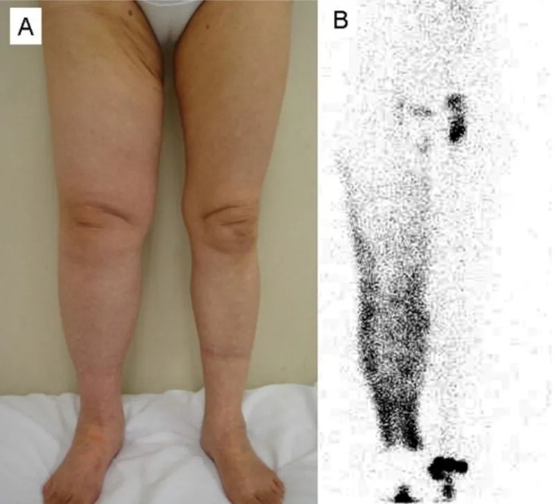 Two-panel medical image: swollen legs beside a scan showing dark leaking spots throughout the leg